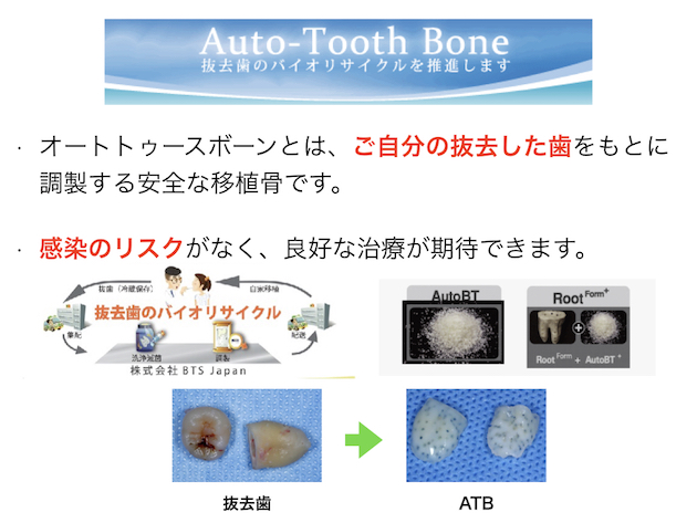 オートトゥースボーンとは、ご自分の抜去した歯をもとに調製する安全な移植骨です。感染のリスクがなく、良好な治療が期待できます。